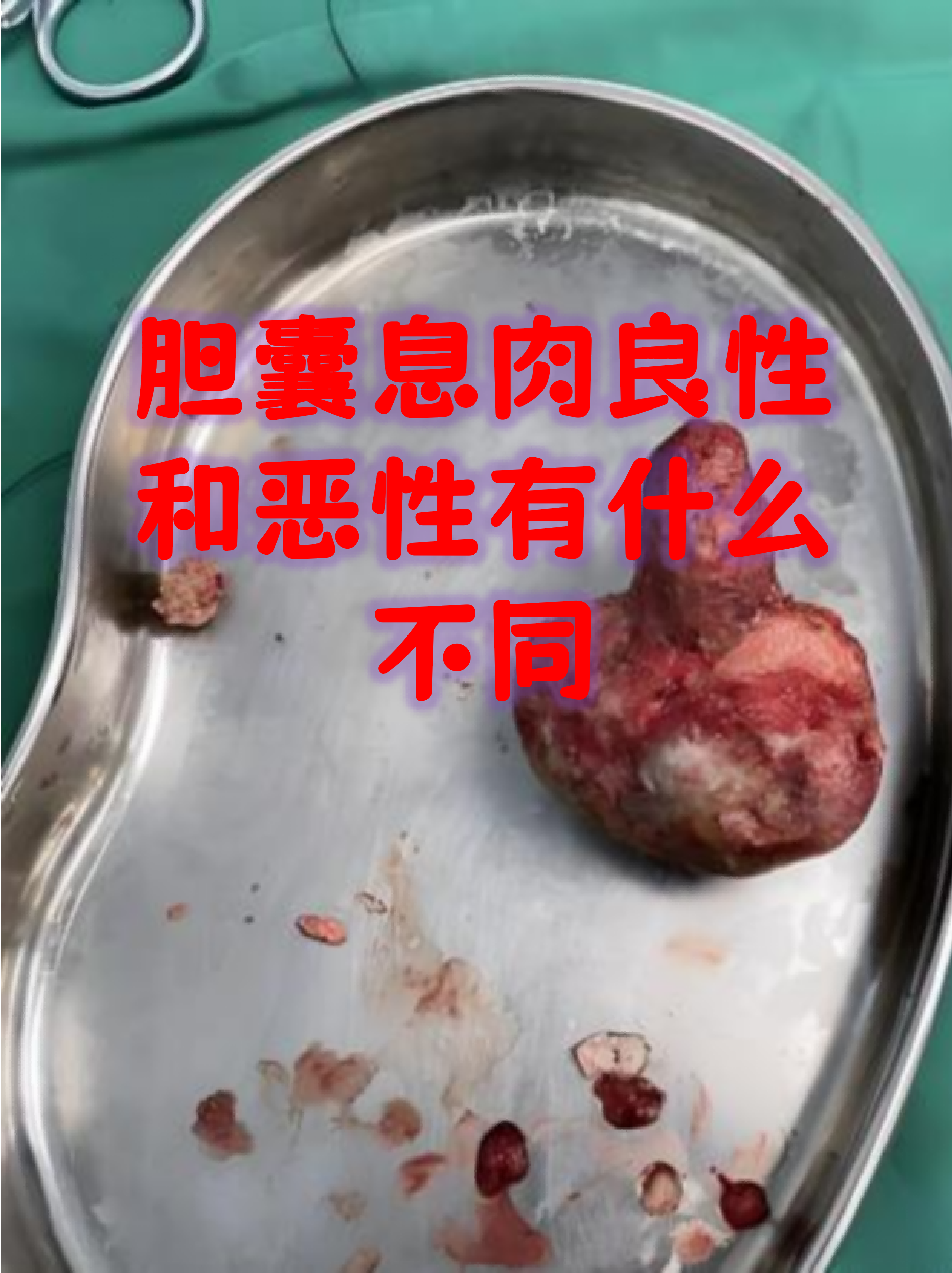 胆囊息肉最佳治疗方法