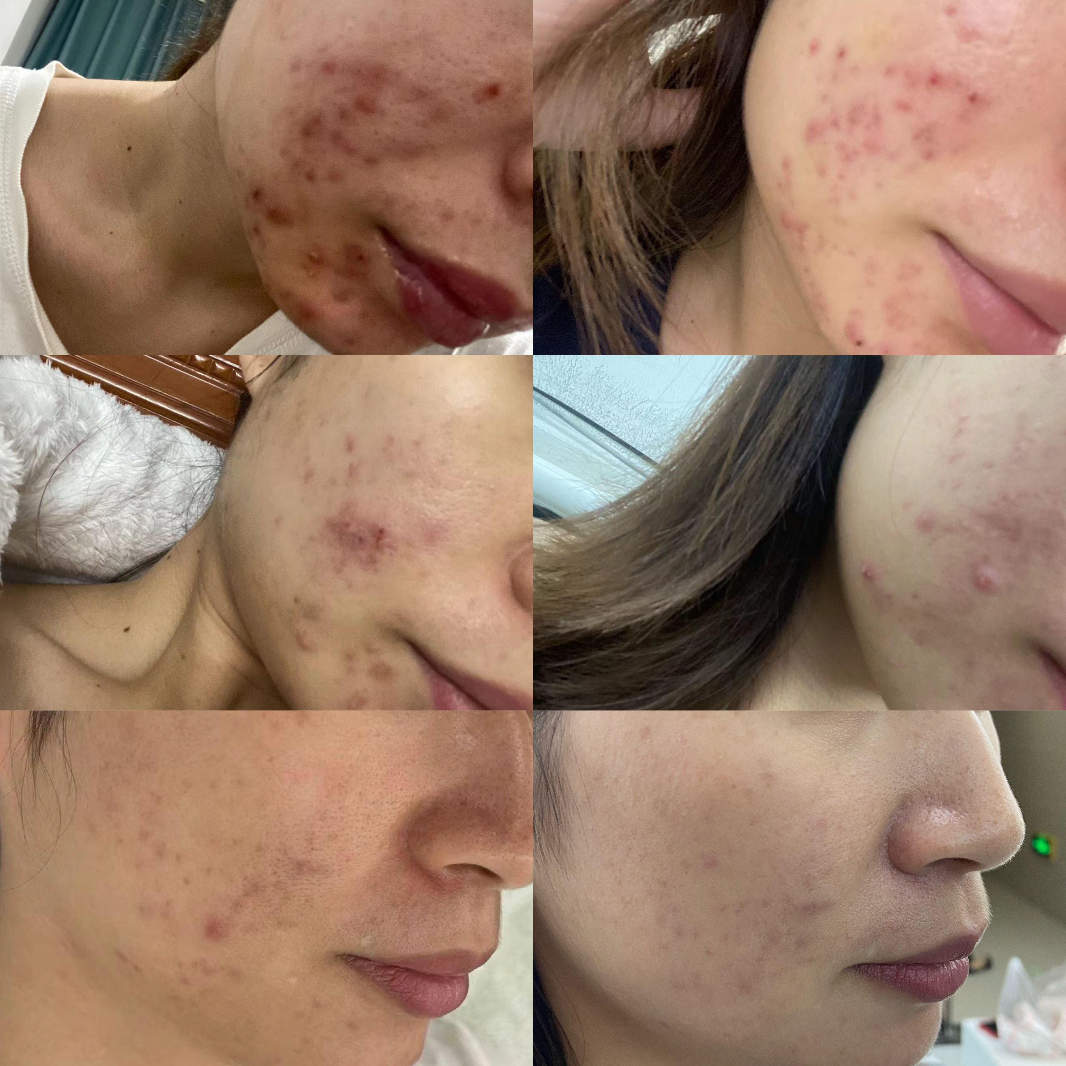 脸上长白色脓包怎么办