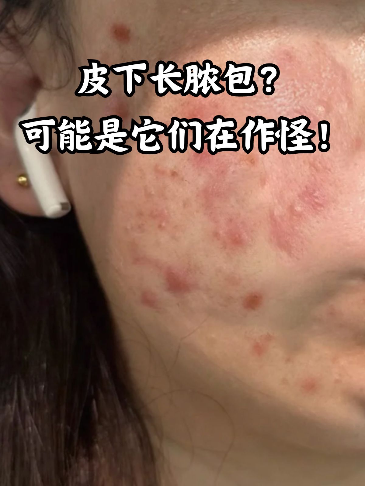 脸上长白色脓包怎么办