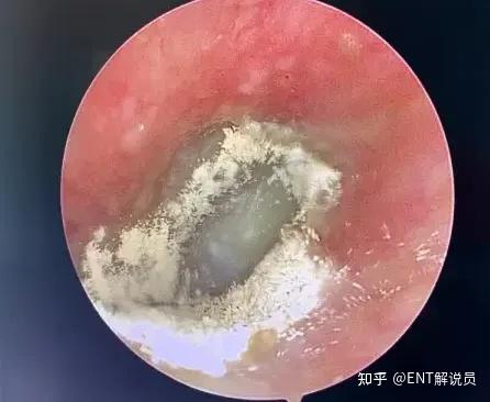 耳朵进水了会自己好吗