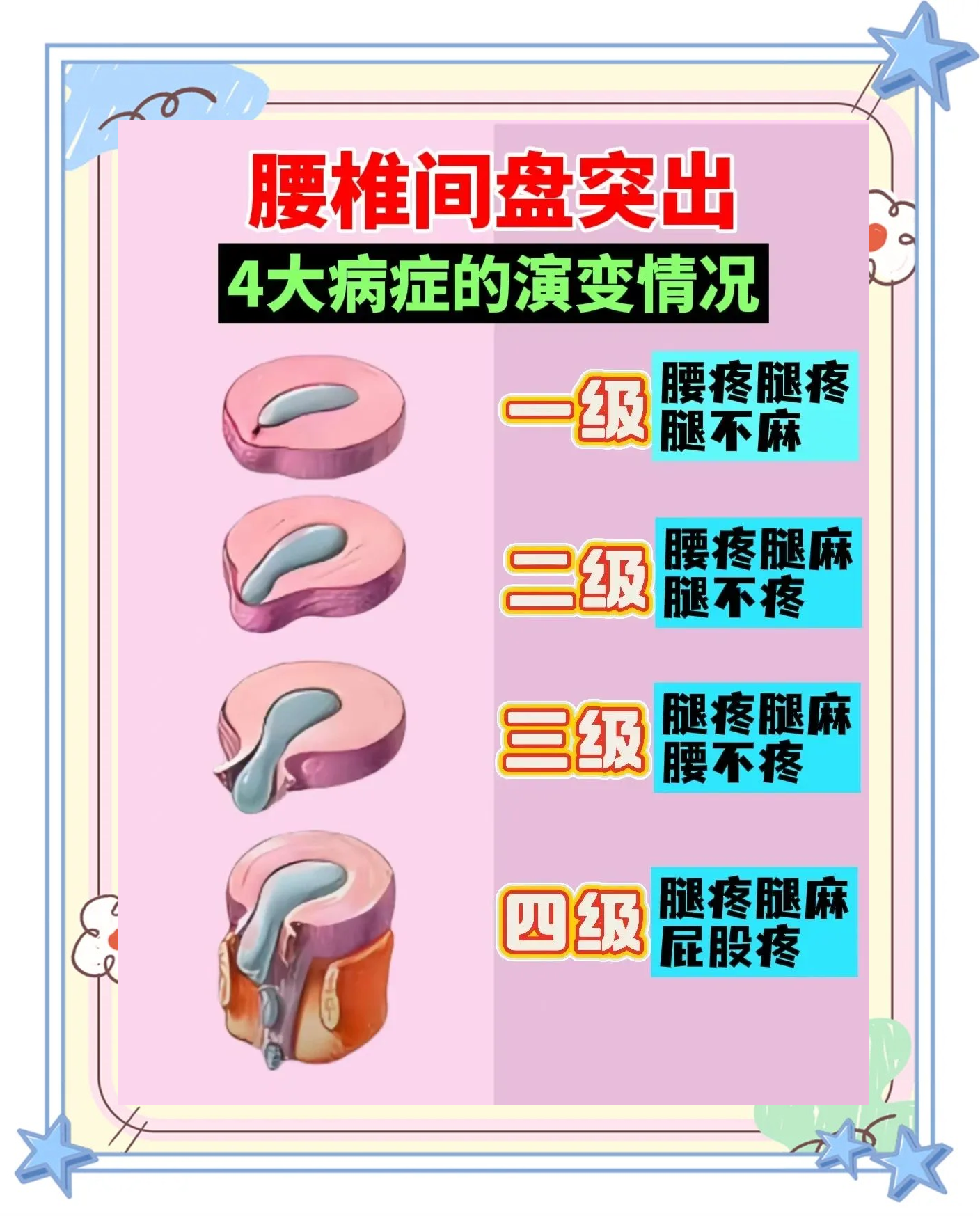 腰椎间盘突出有哪些症状