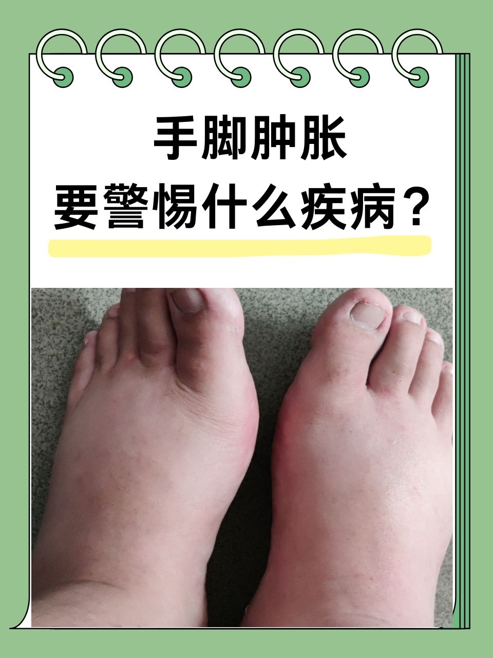 脚浮肿是怎么回事