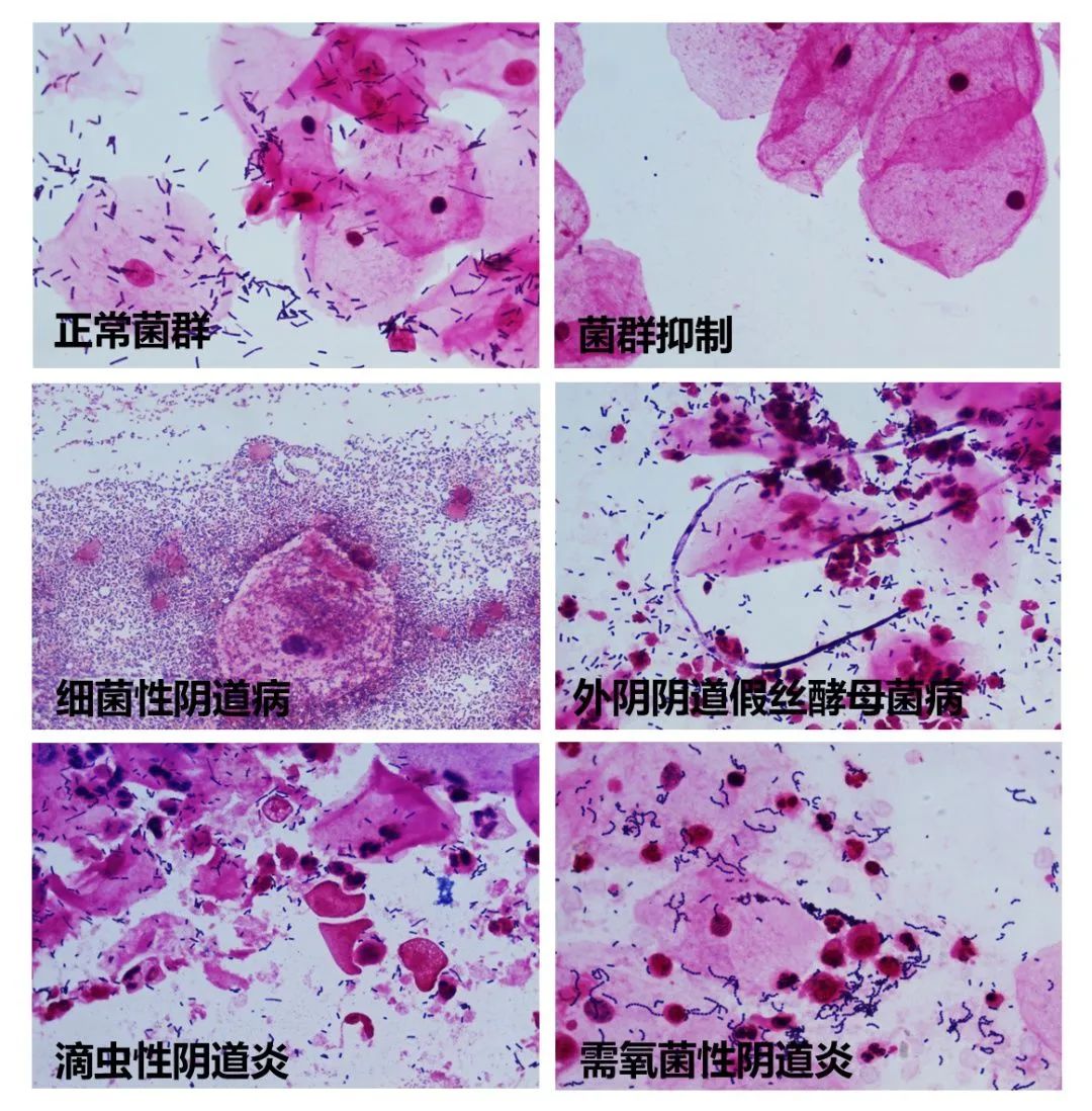 得了阴道炎还能怀孕吗?