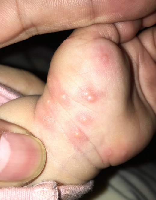 日光性皮炎症状是什么?