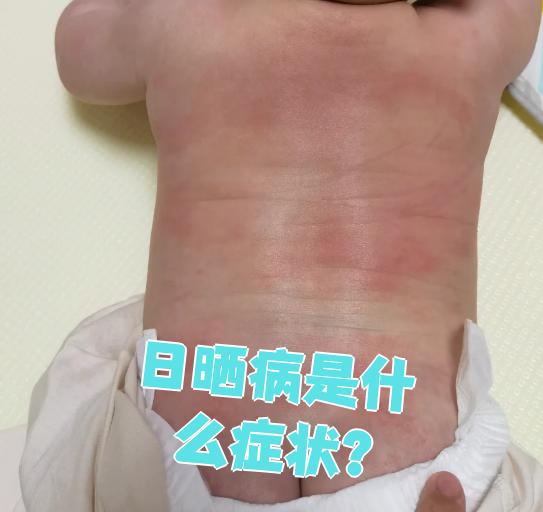 日光性皮炎症状是什么?