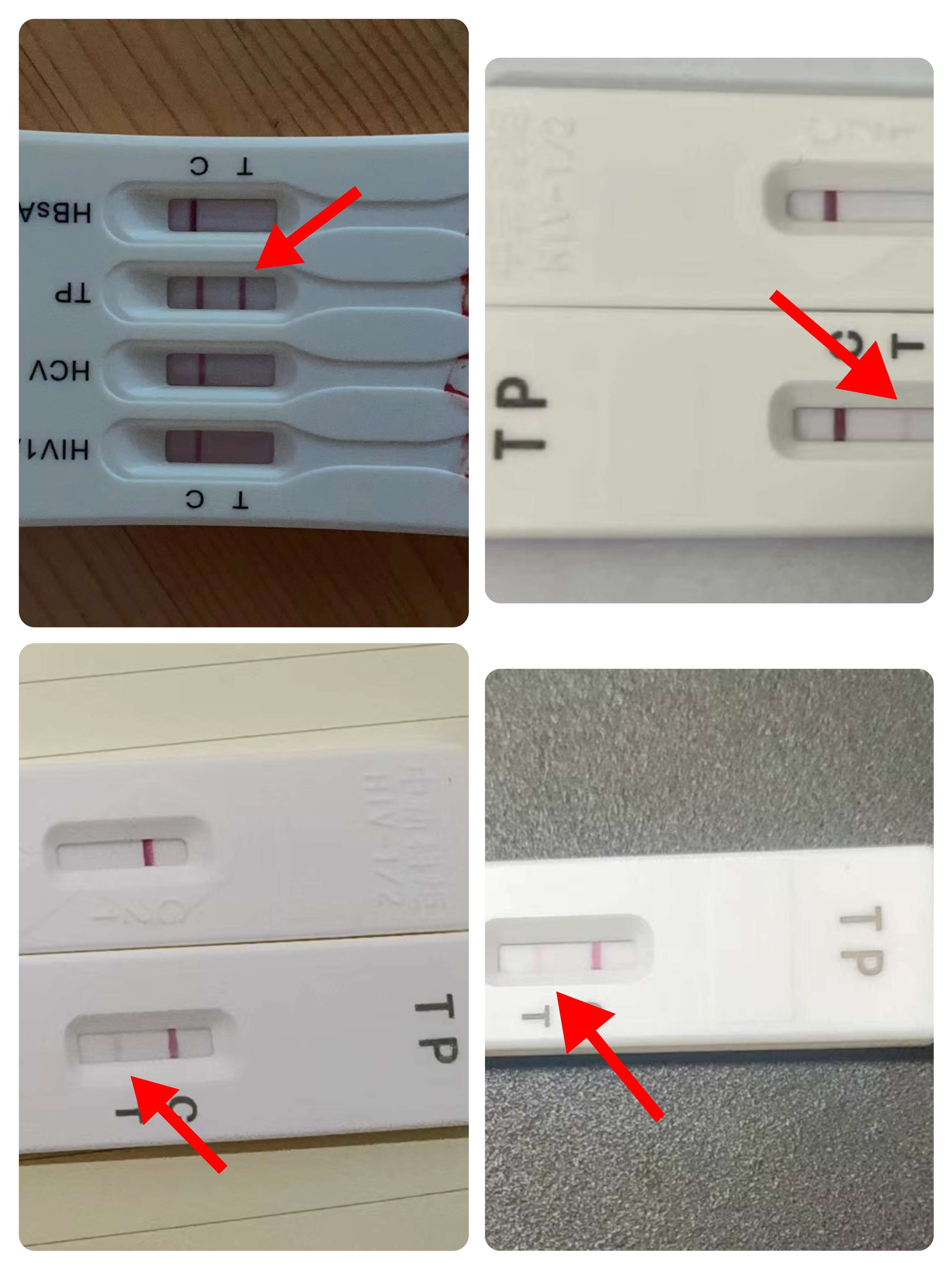 发现梅毒特异性抗体阳性是什么