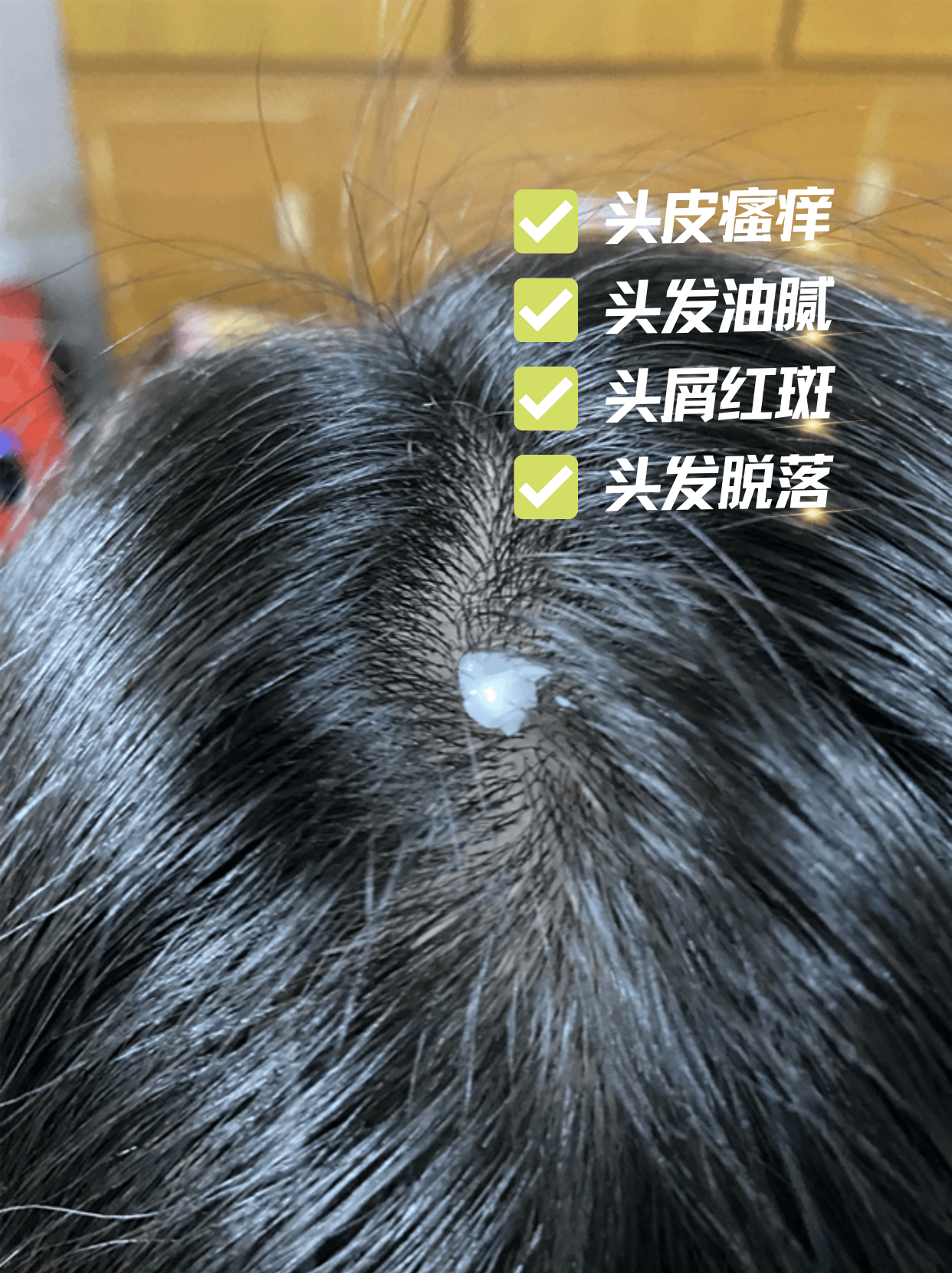 什么是头部脂溢性皮炎?