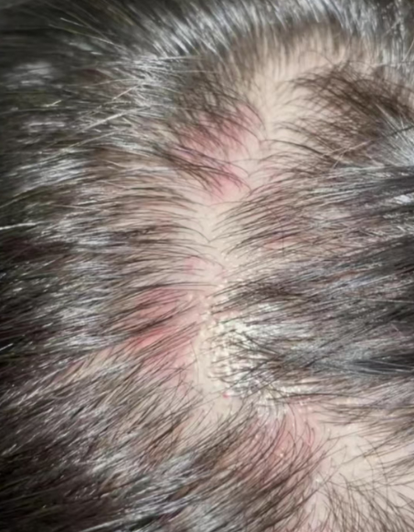 什么是头部脂溢性皮炎?