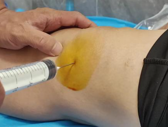 滑膜炎有积液怎么办