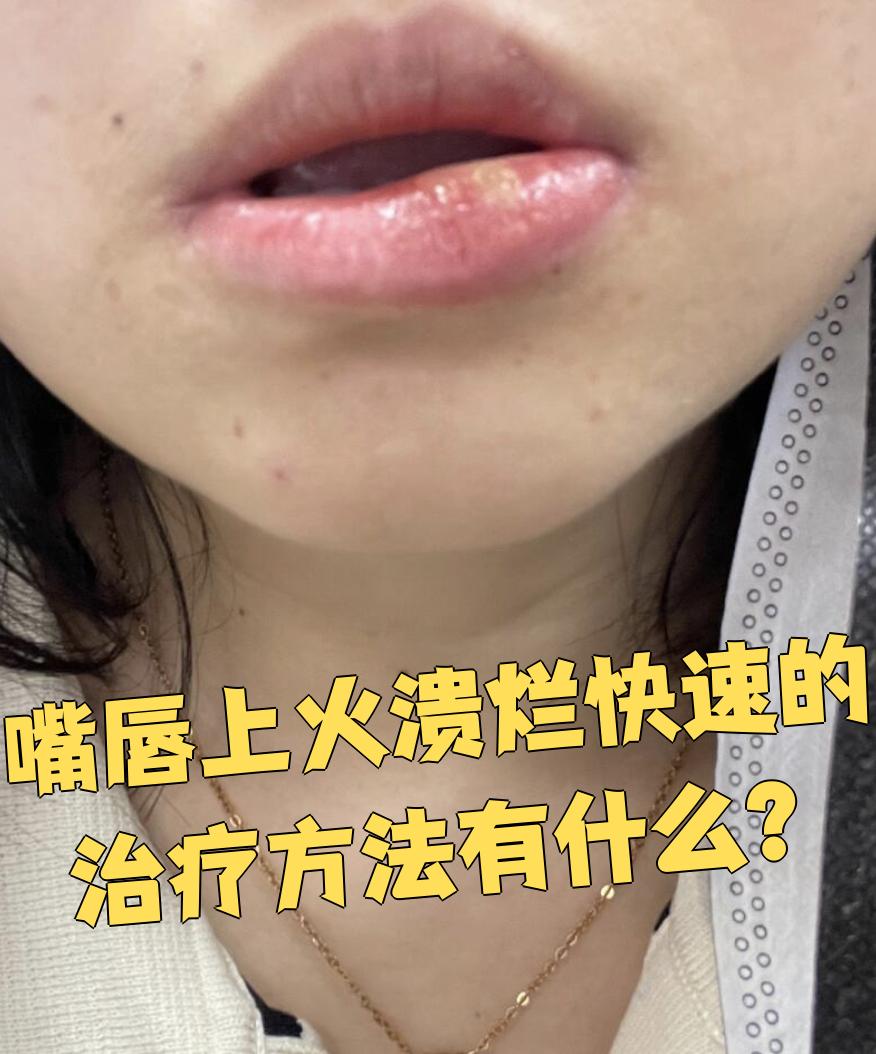 嘴唇起泡溃烂怎么办
