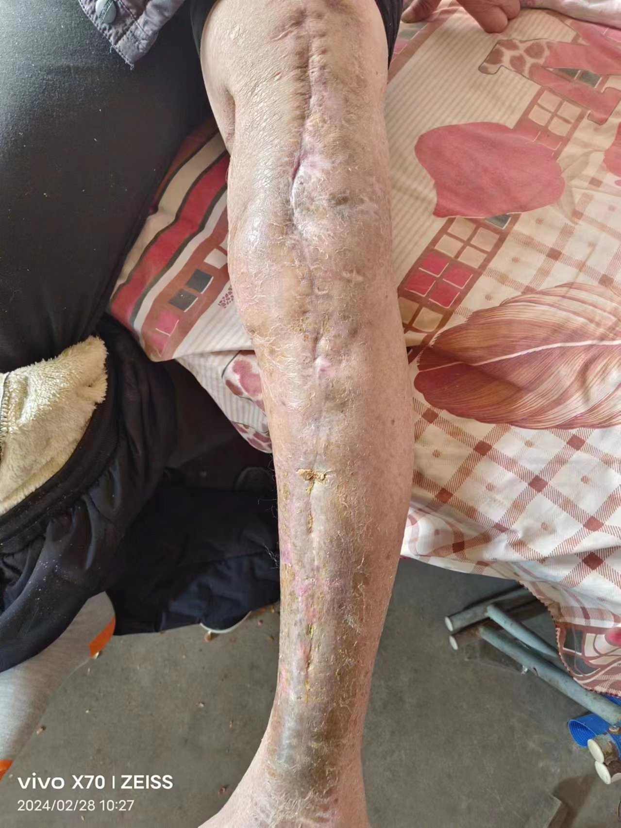 骨髓炎的早期症状