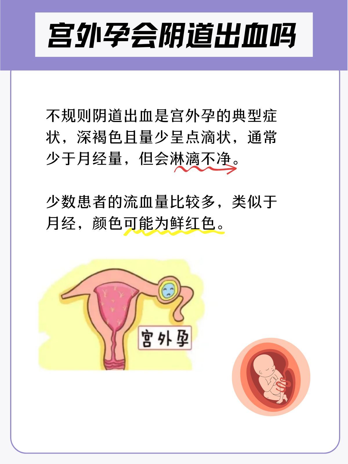 怀孕多久能排除宫外孕