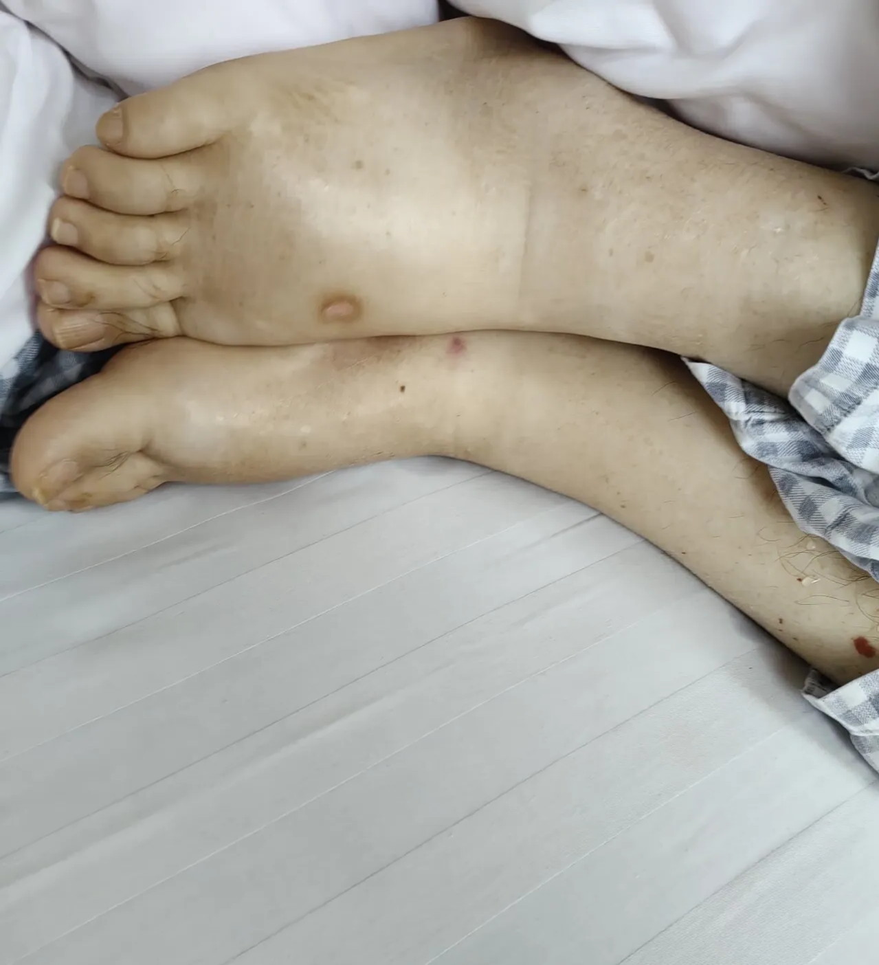 一氧化碳中毒后遗症的症状