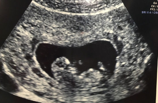 怀孕多久可以做b超