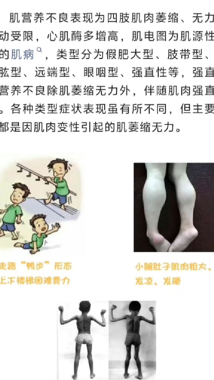 肌营养不良症的症状