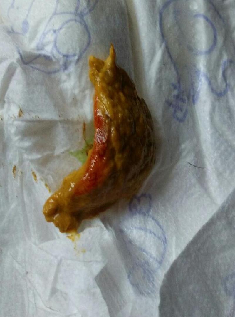 大便时肛门出血