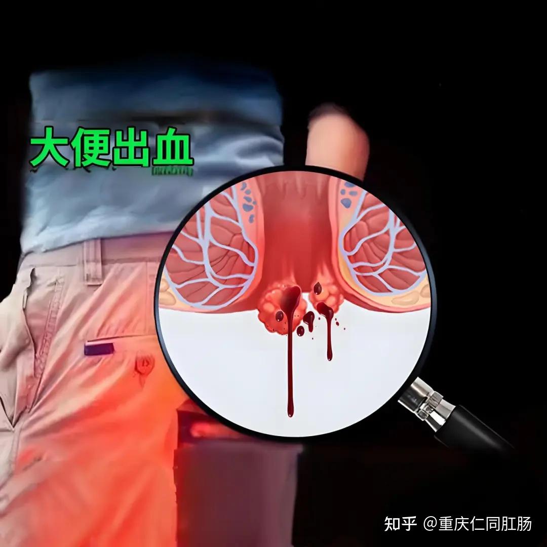 大便时肛门出血