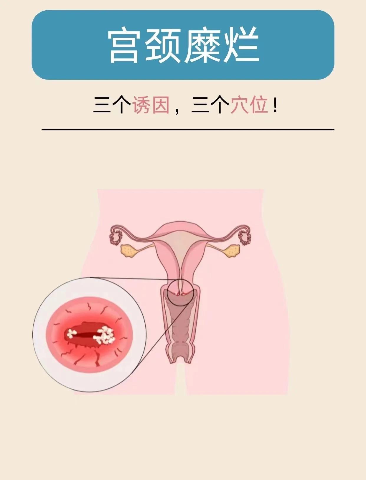 得了宫颈糜烂怎么办?