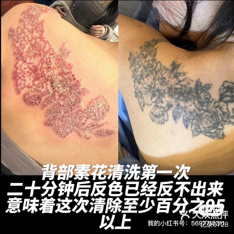 洗纹身后可以当兵吗?