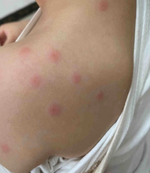 身上起红疹子是怎么回事