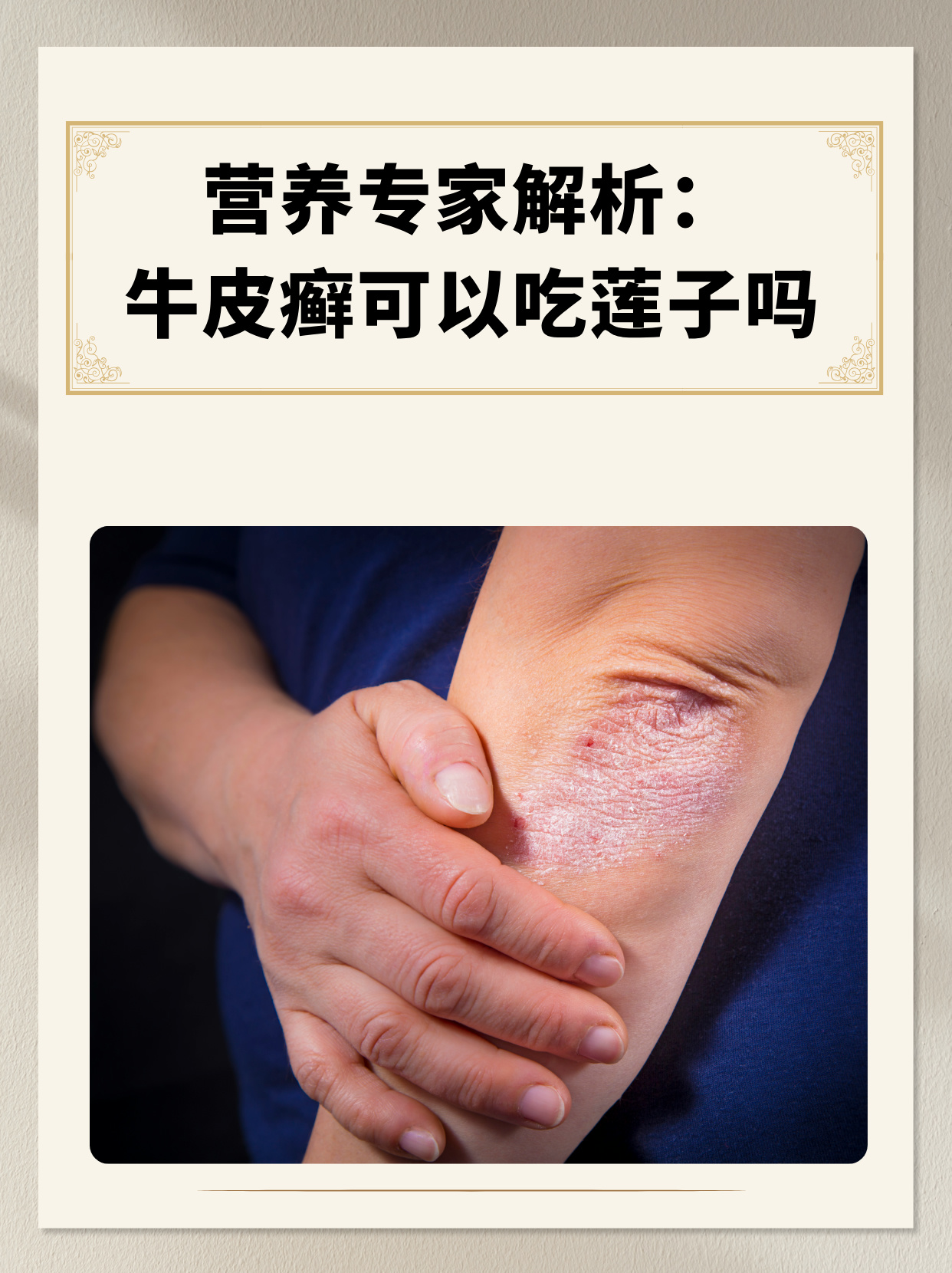 牛皮癣怎么治疗的?