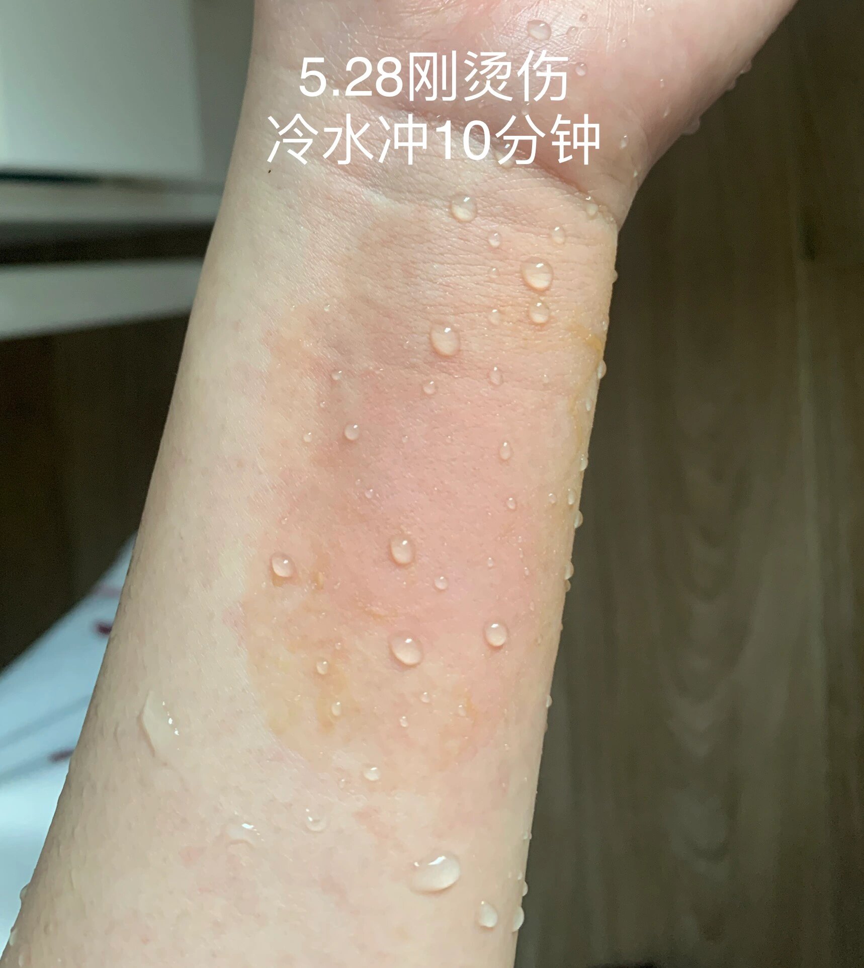 被蒸汽水烫伤怎么办
