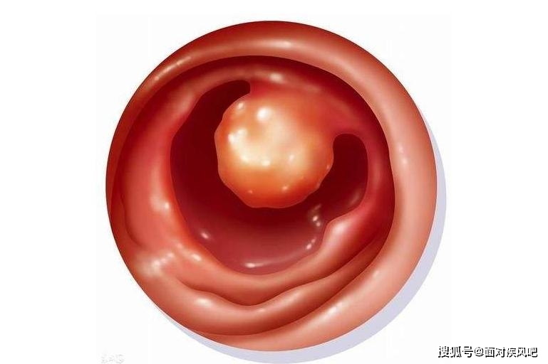 阴道口处下方长了肉疙瘩疼