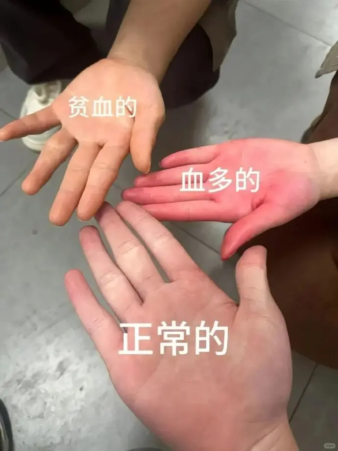 溶血性贫血的症状