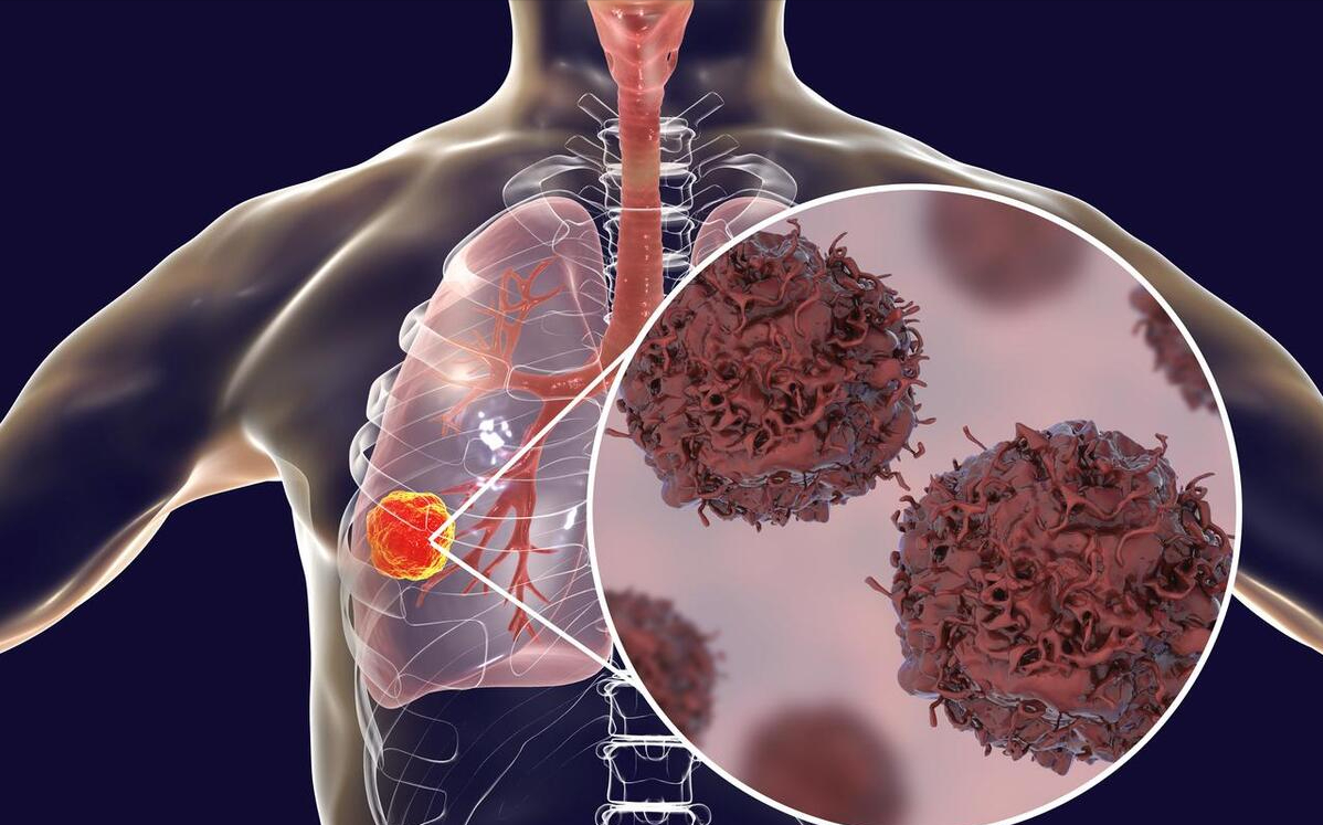 肺癌中期的症状是什么