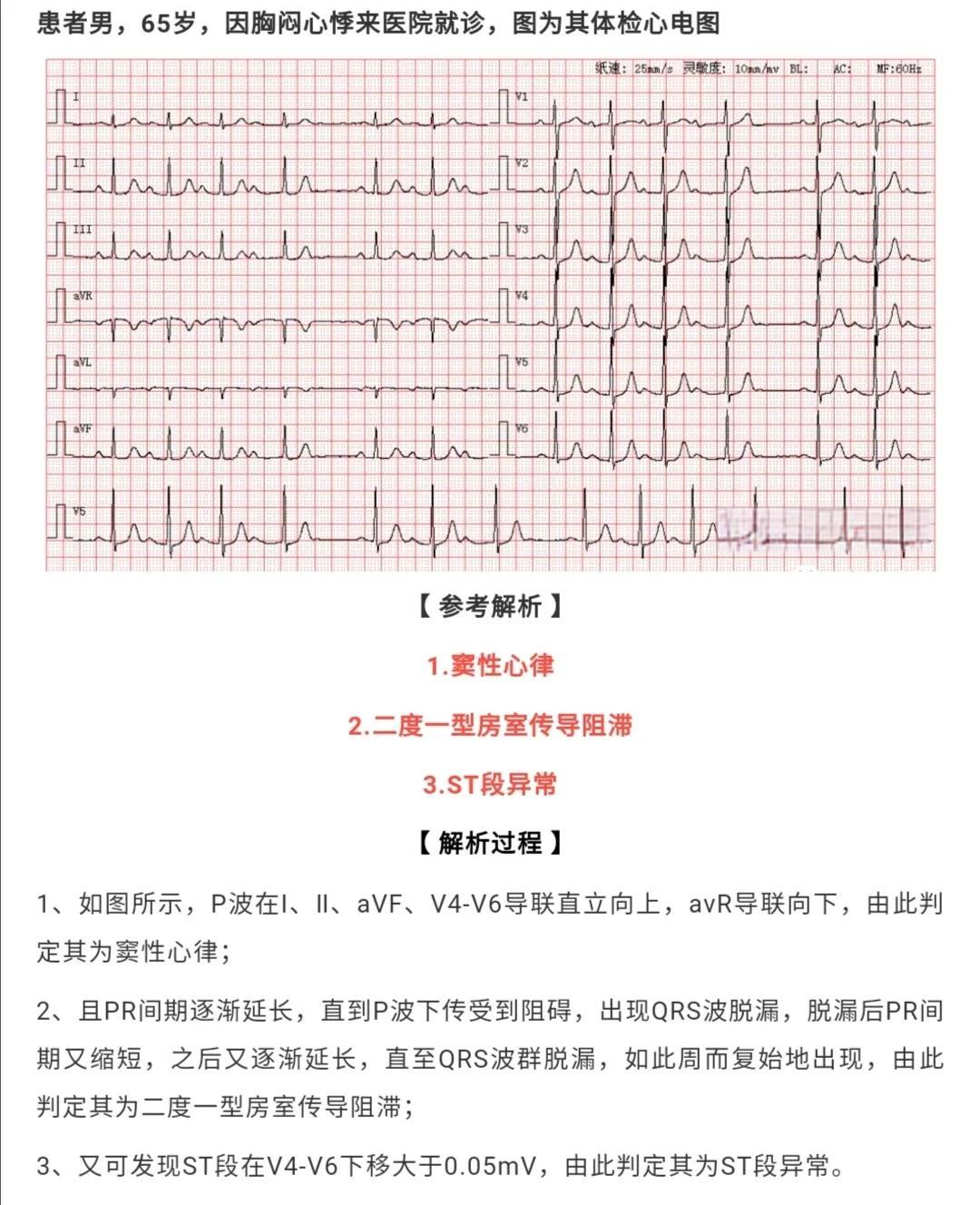一度房室传导阻滞是什么意思