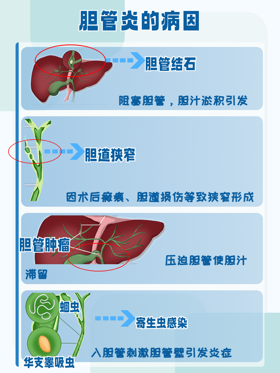 胆总管扩张是什么病