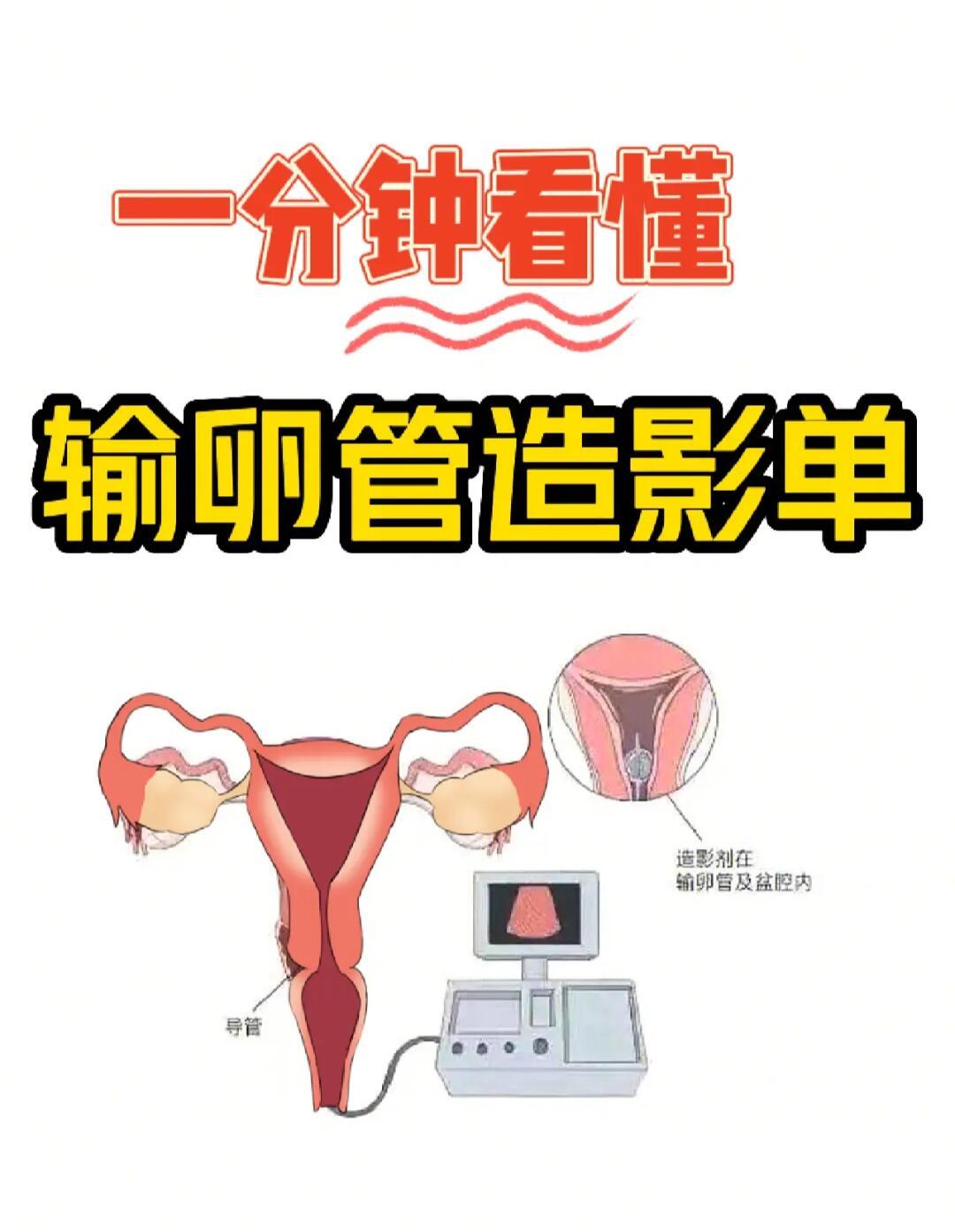 做输卵管造影需要多少钱