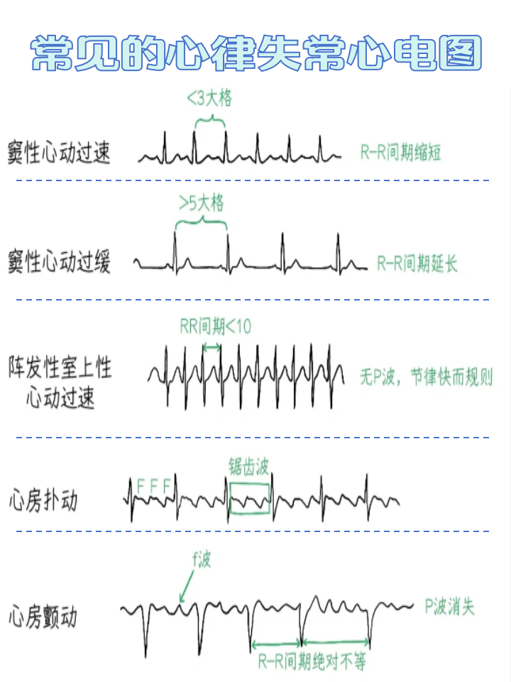 什么是心率不齐