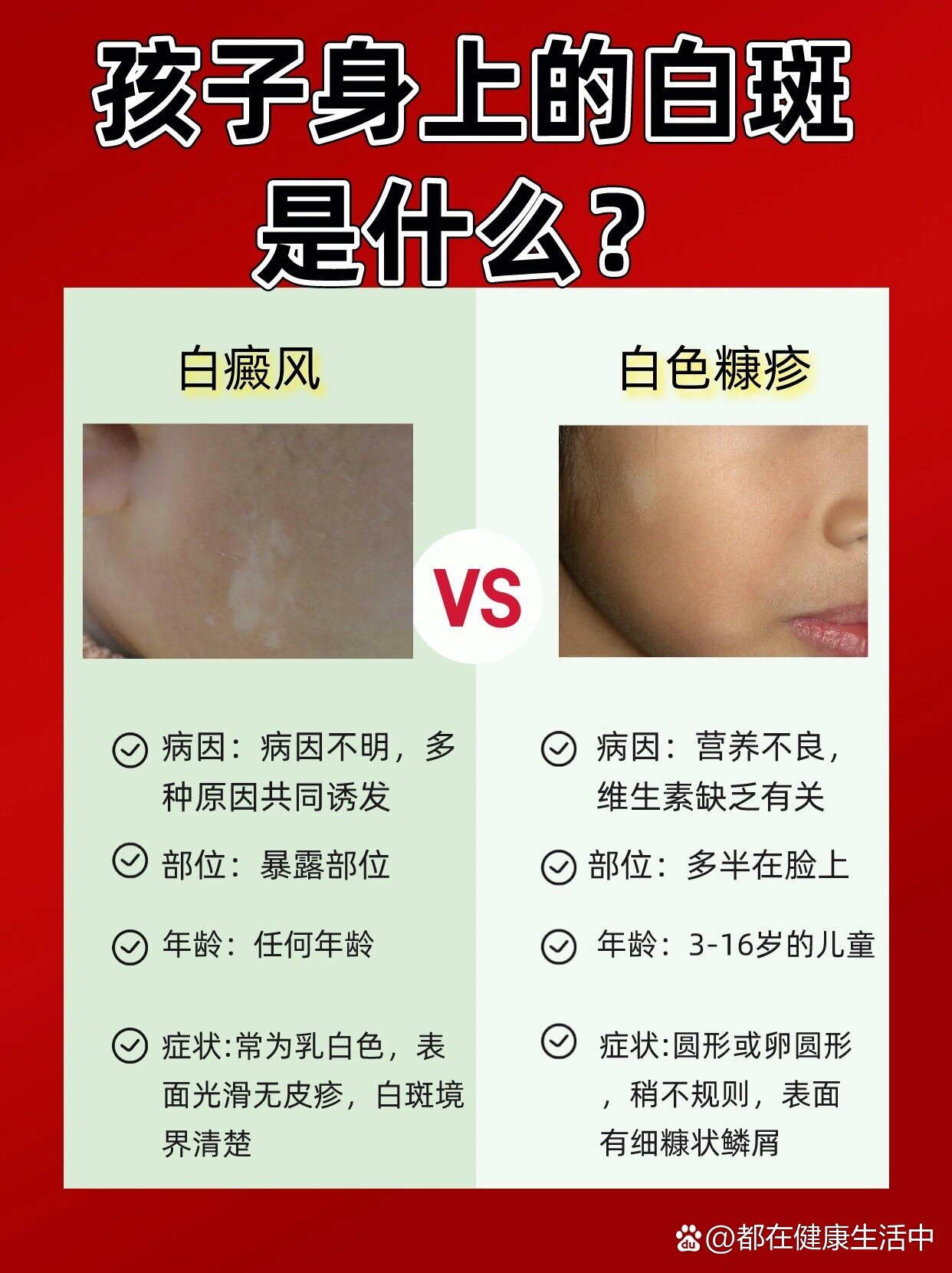 白癜风会遗传吗