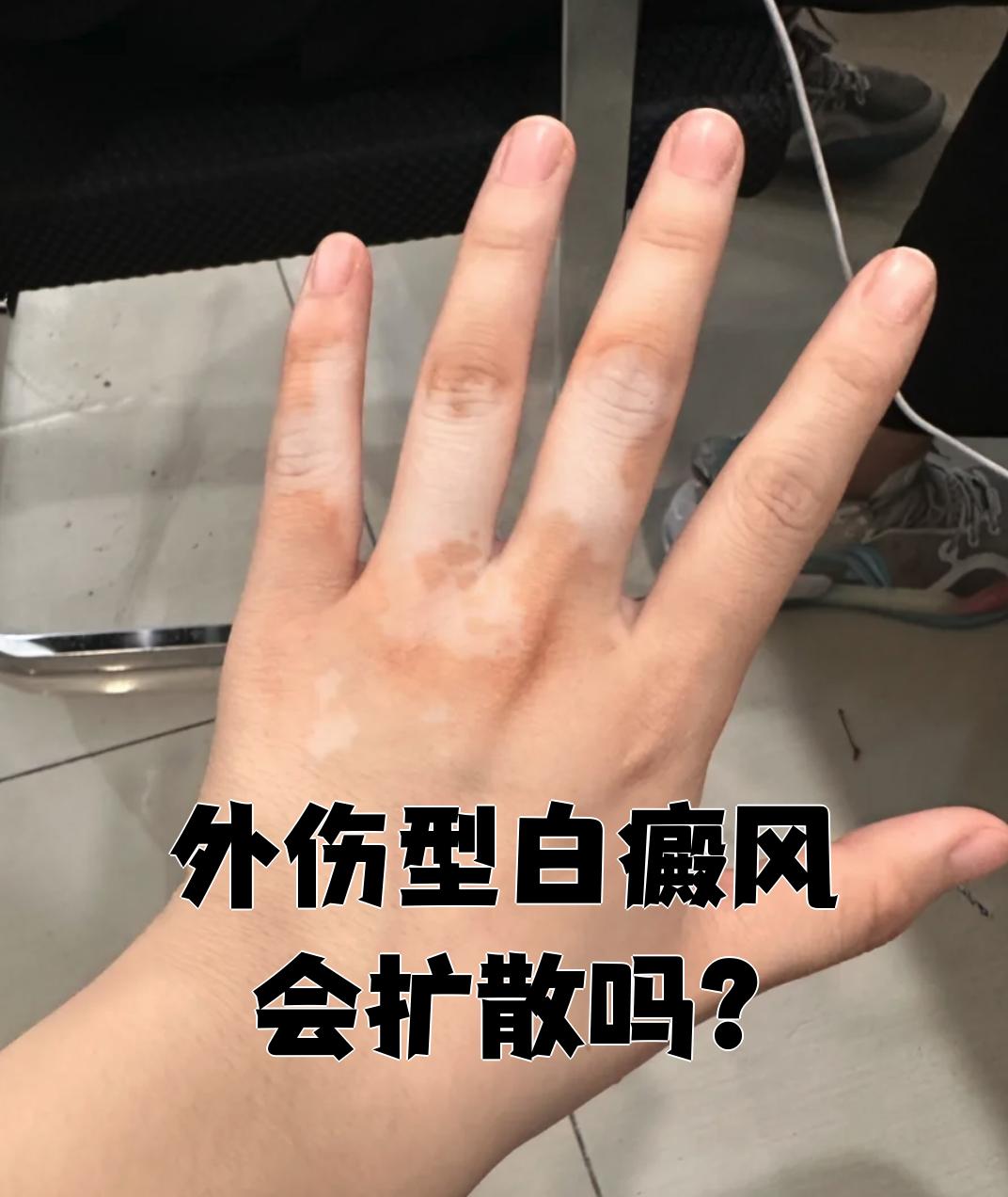 白癜风会遗传吗