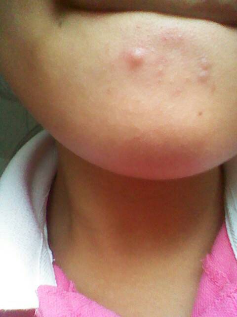 下巴有一个硬疙瘩,很疼