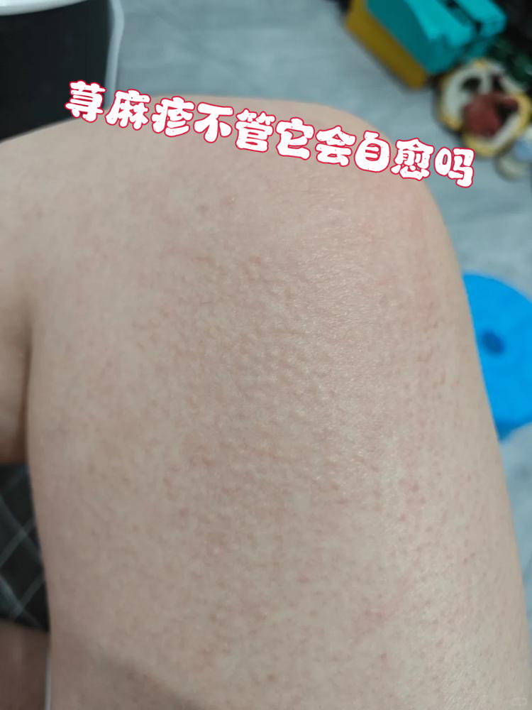 荨麻疹自己会好吗