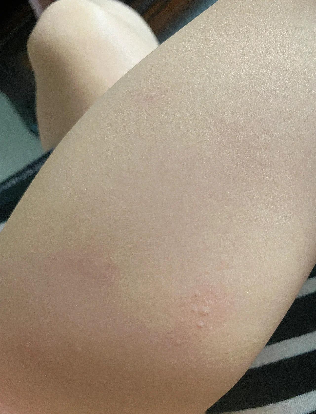 荨麻疹自己会好吗