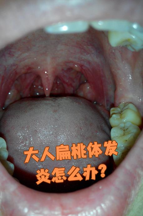 扁桃体炎会引起咳嗽吗