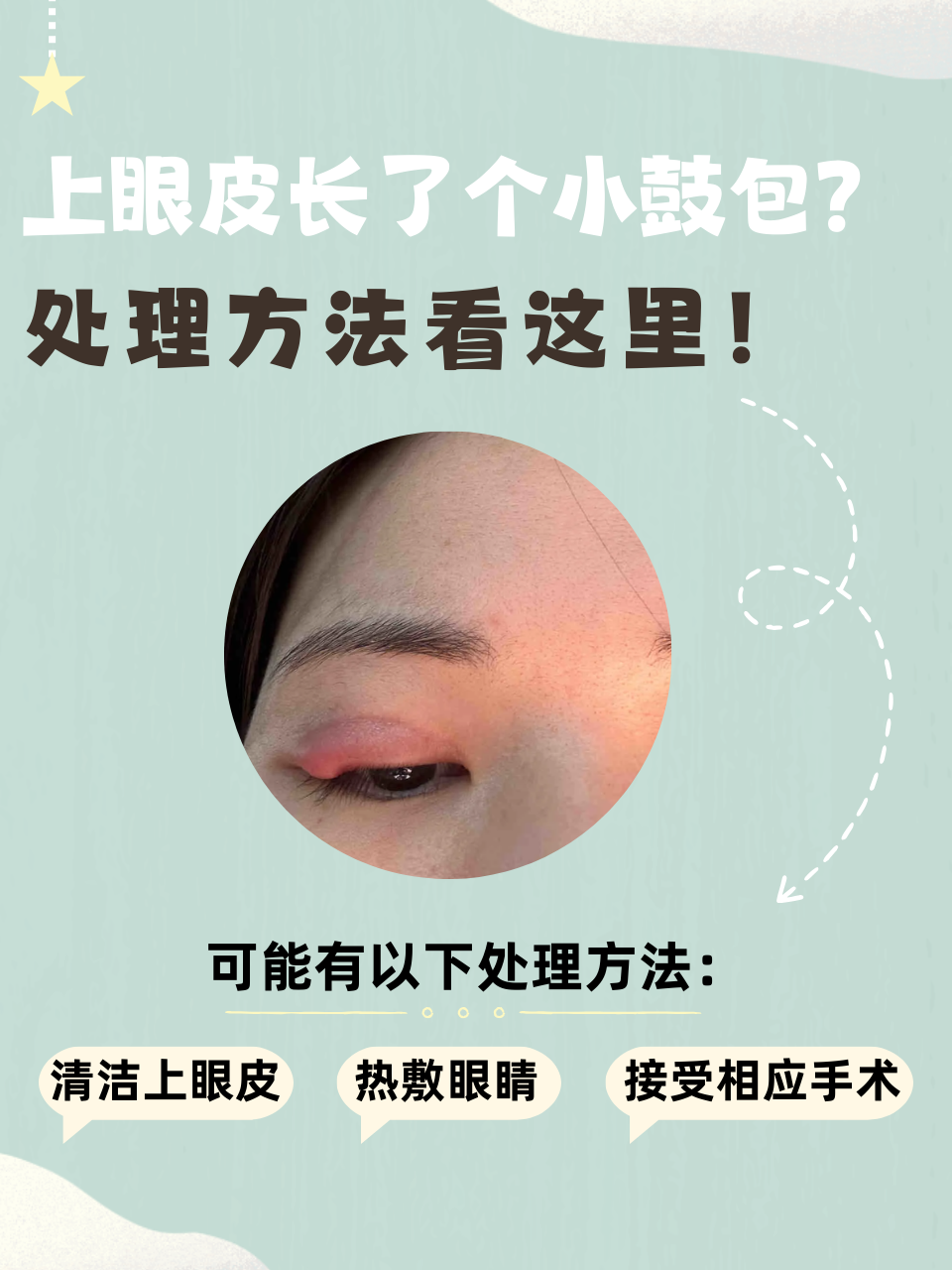 眼角脂肪粒怎么去掉