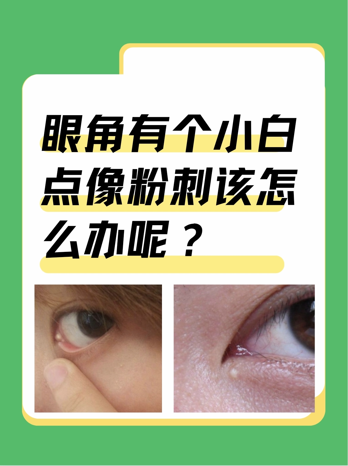 眼角脂肪粒怎么去掉