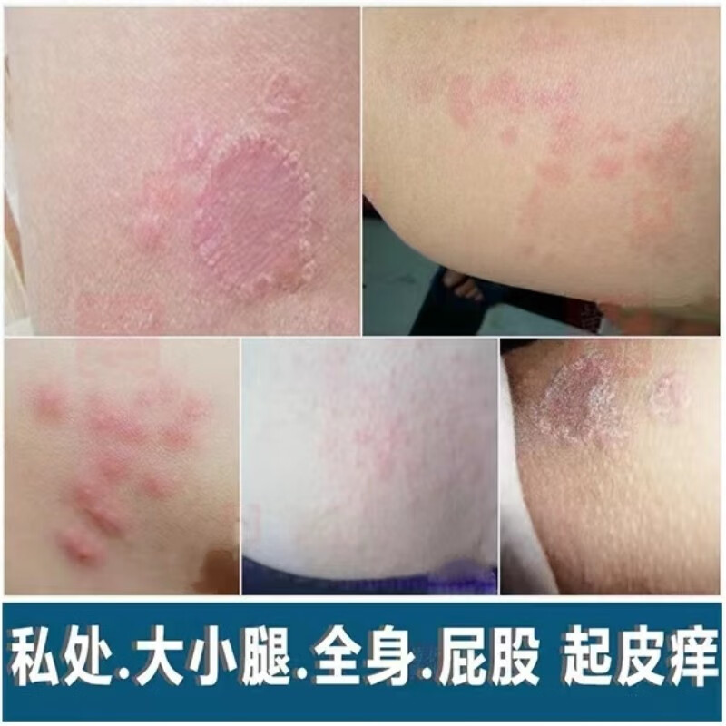 大腿内侧瘙痒怎么回事