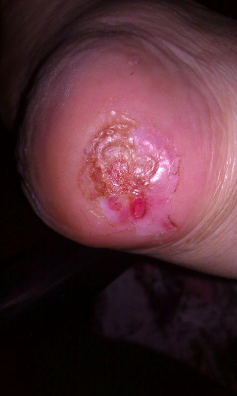 被烟头烫伤怎么办?