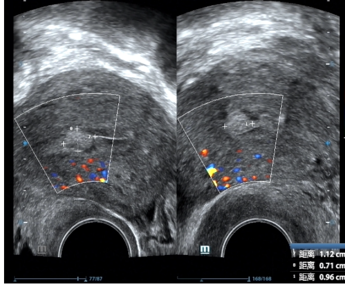 子宫内膜癌的超声表现
