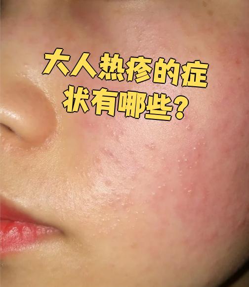 热痱子的症状有哪些