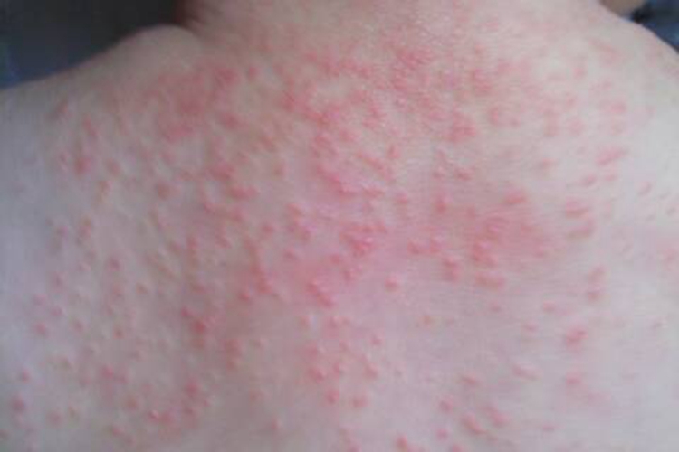 热痱子的症状有哪些