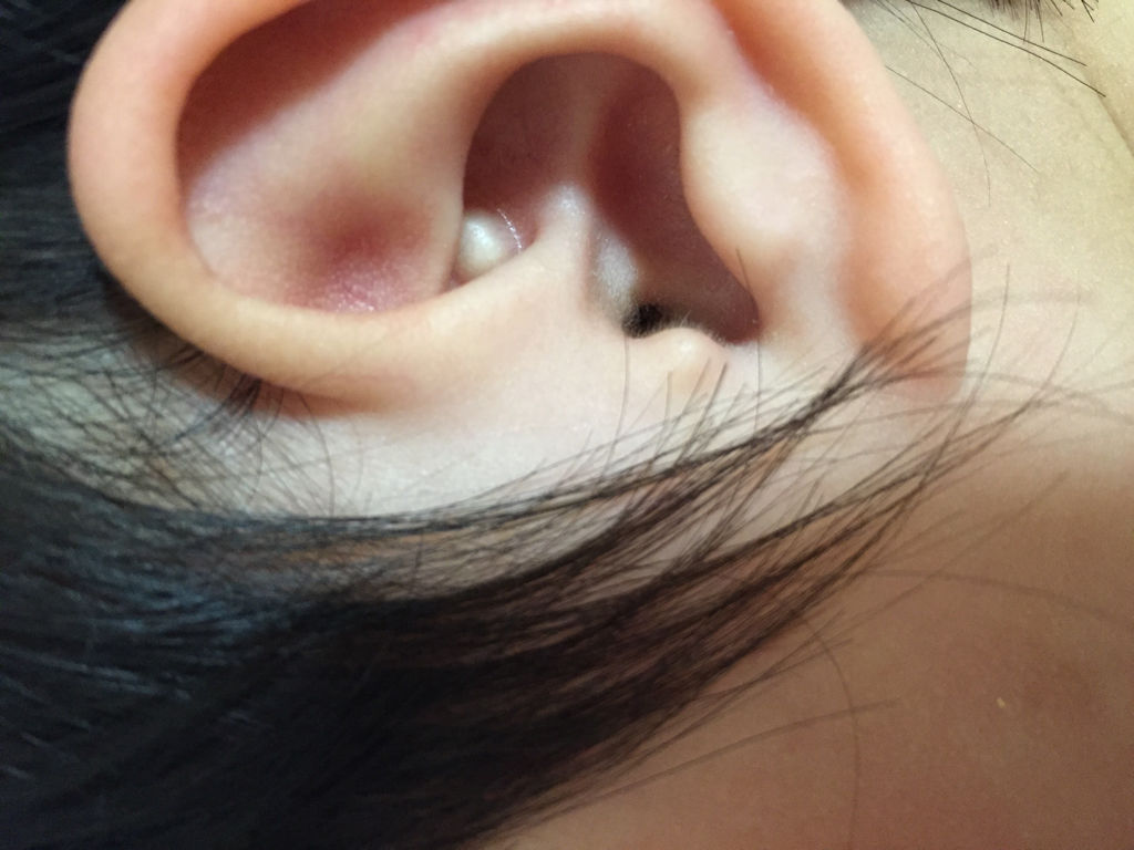 耳朵里面长了一个疙瘩