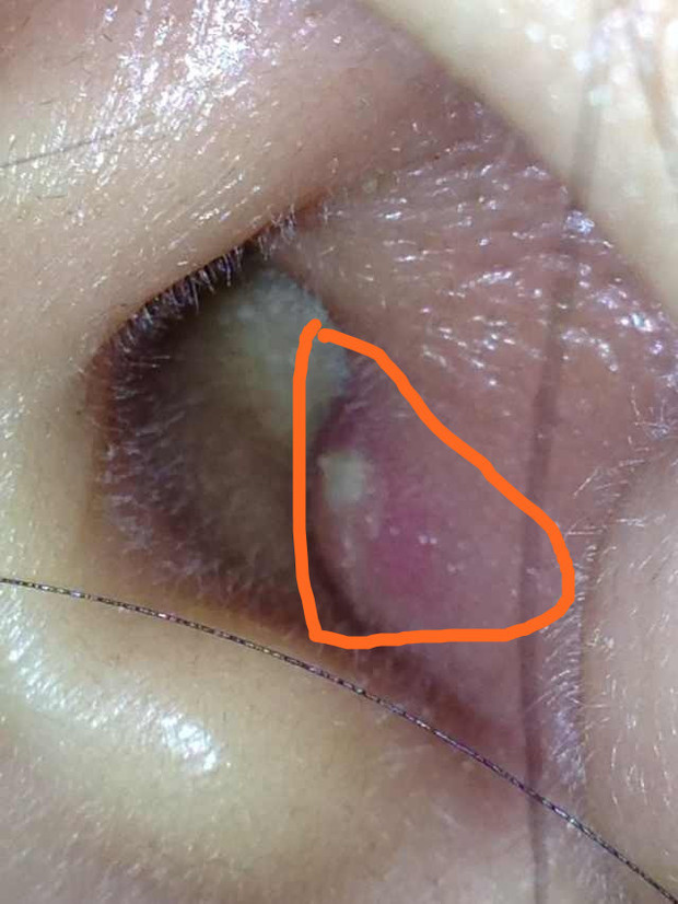 耳朵里面长了一个疙瘩