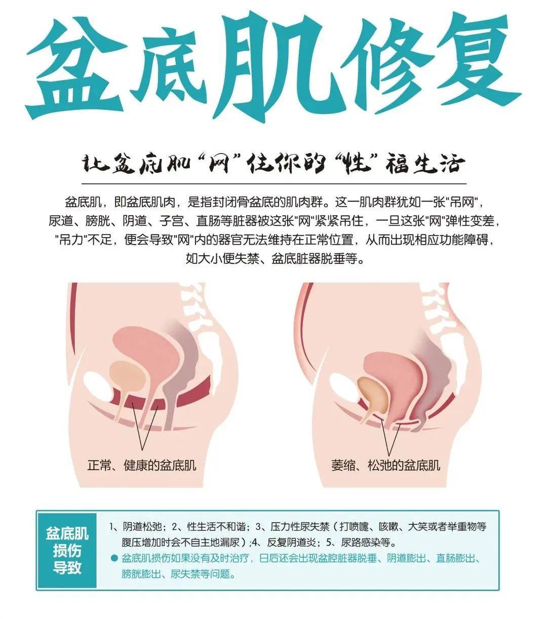 盆底康复治疗有效吗