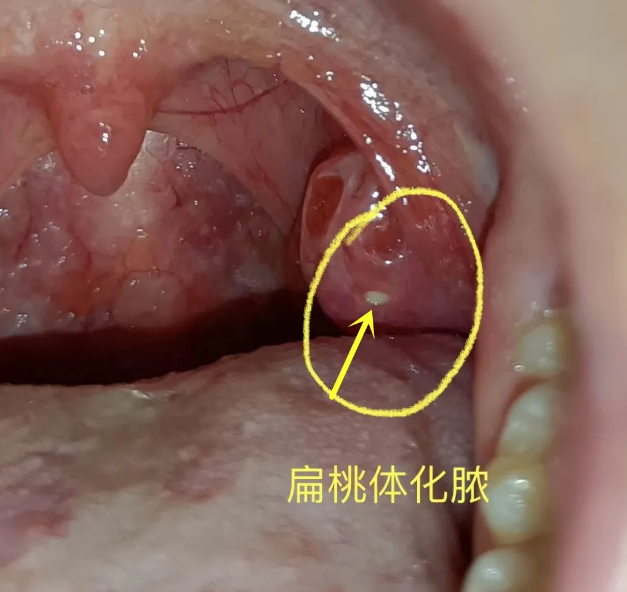 鼻炎有哪些症状